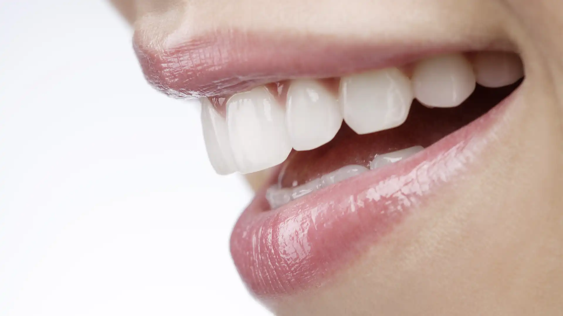 Dental Veneers Cost